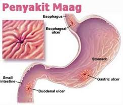 Illustration for article titled Obat Maag Ibu Menyusui